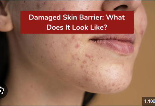 Damaged Skin Barrier